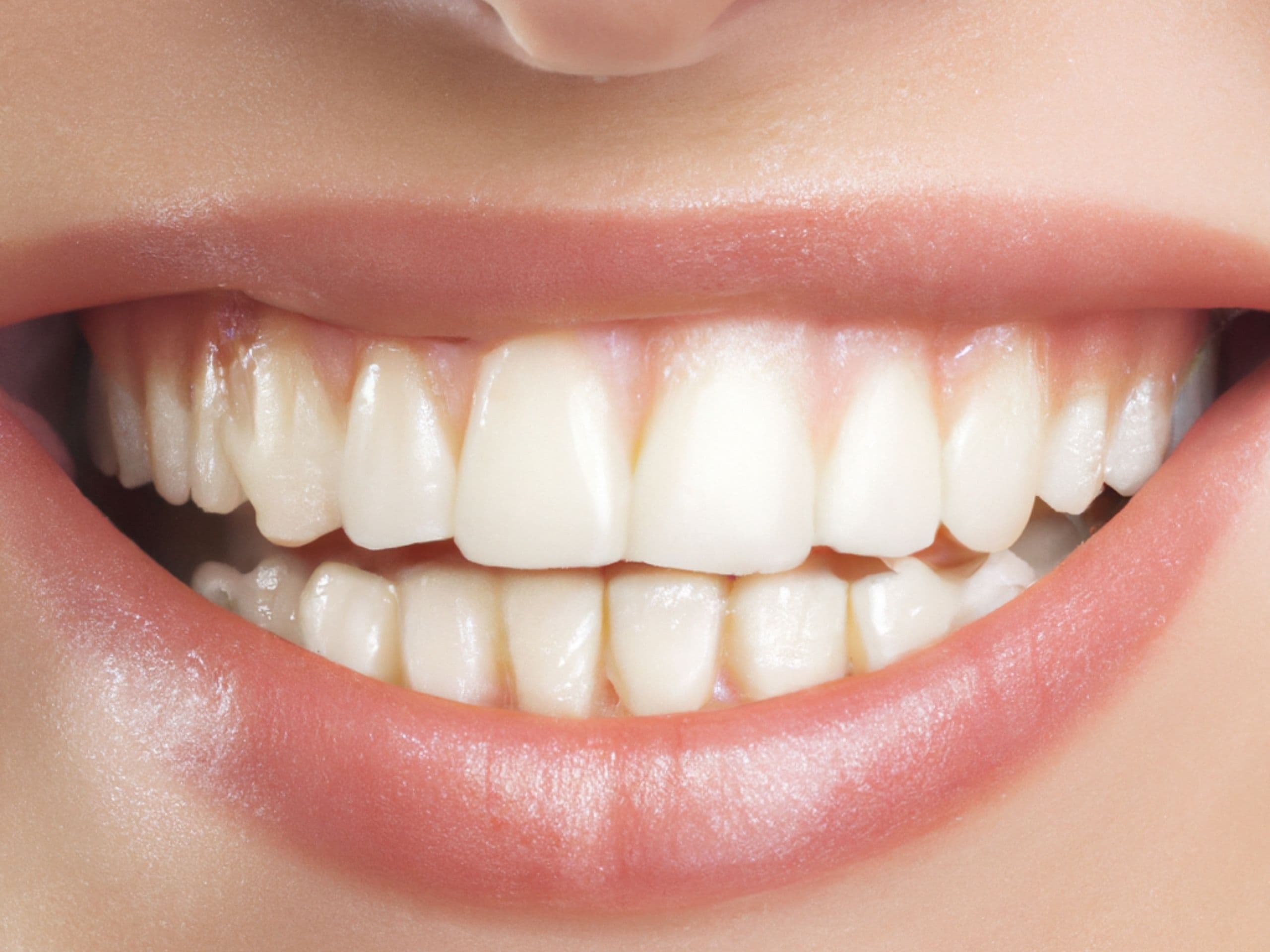 Albirea dentară: profesională vs. acasă — ce funcționează?