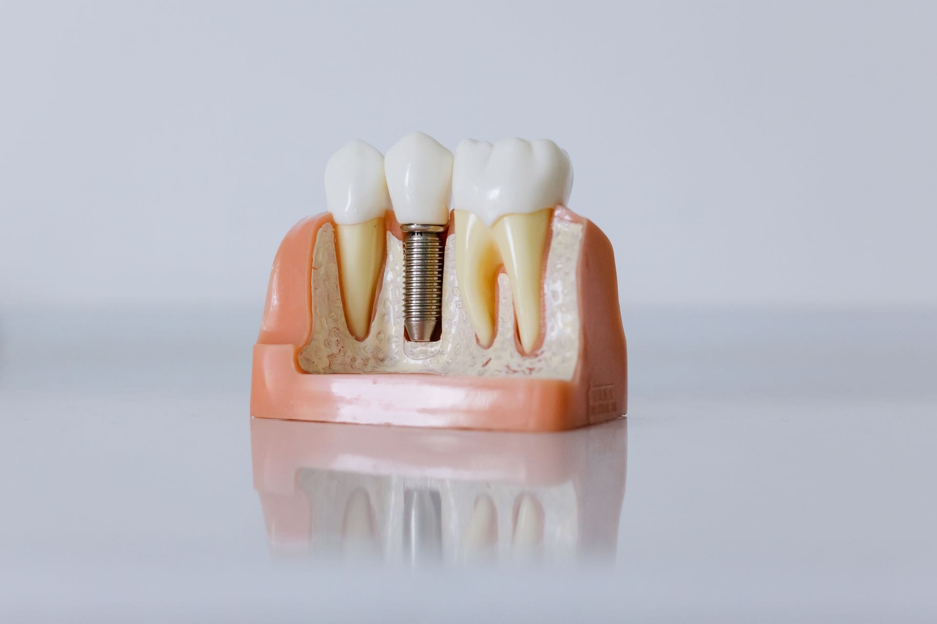 Ghid complet: tot ce trebuie să știi despre implantul dentar